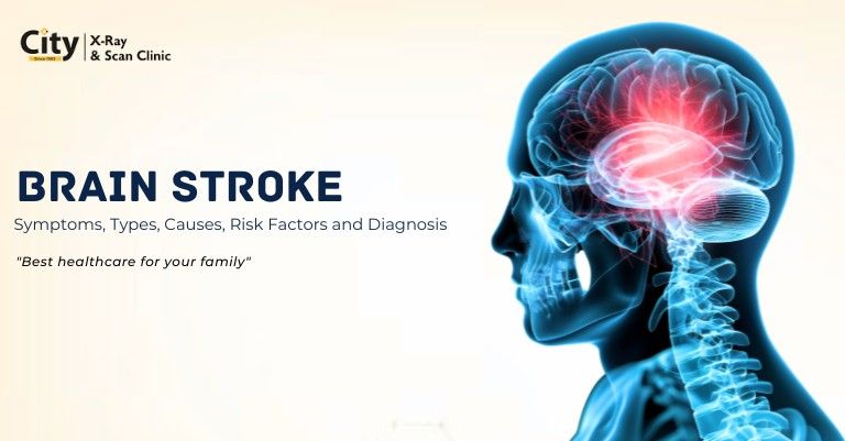 Brain Stroke: Symptoms, Types, Causes, Risk Factors, Diagnosis, and Treatment