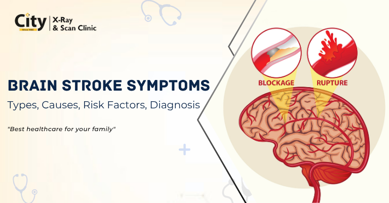 Brain Stroke: Symptoms, Types, Causes, Risk Factors, Diagnosis, and Treatment