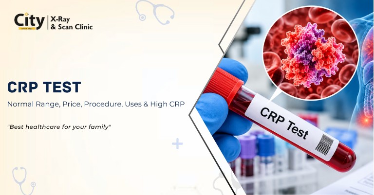 CRP Test: Normal Range, Price, Procedure, Uses, and What High CRP Levels Mean