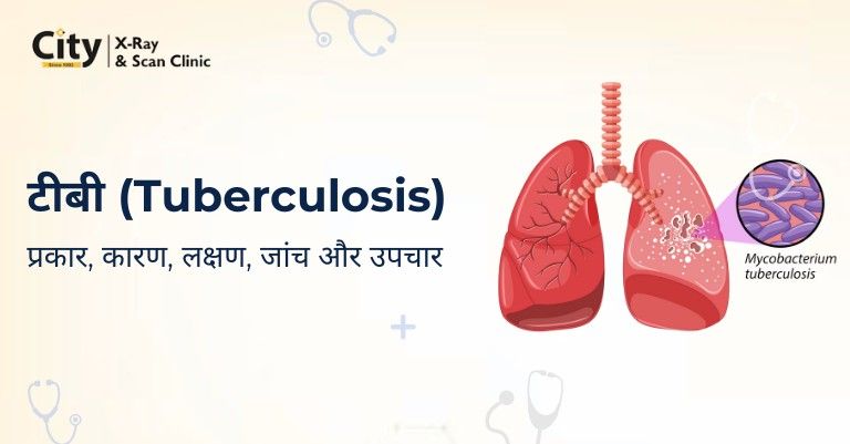 टीबी के प्रकार, कारण, लक्षण, जांच और उपचार | टीबी में क्या खाना चाहिए और क्या नहीं