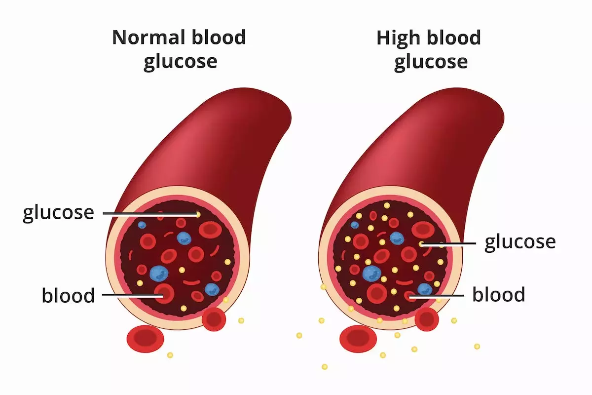 Type 2 Diabetes Symptoms, Causes and tests