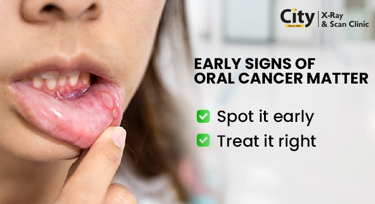 Oral Cancer Early Signs, Stages, and Tests to Detect