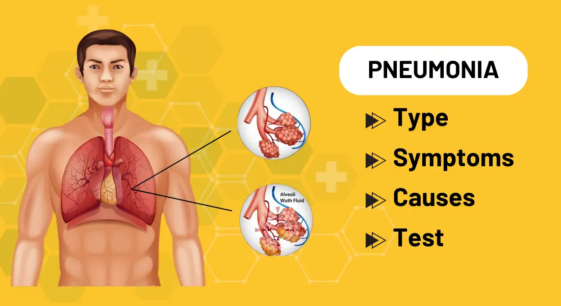 Viral Pneumonia: Type, Symptoms, Causes, and Test